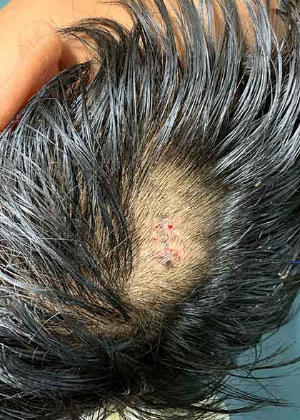 Dermatofibroma-after-1