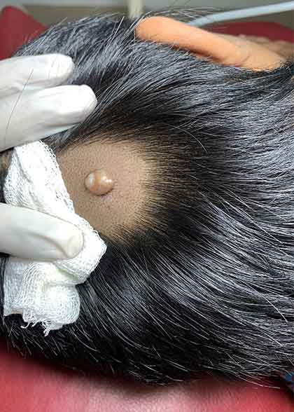 Dermatofibroma