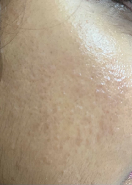 Treatment_after
