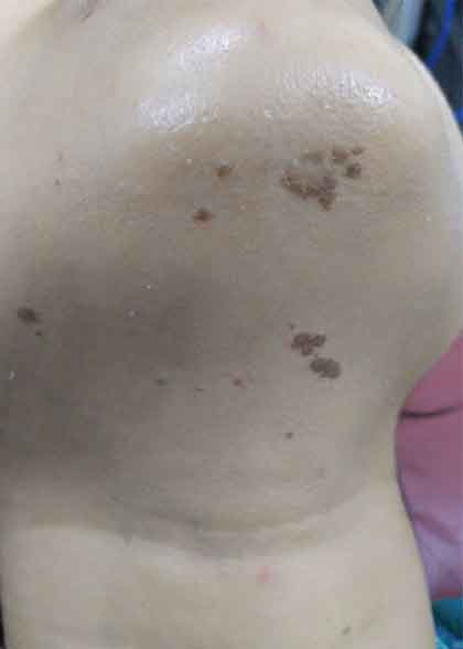 Verruca-vulgaris-before-1