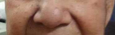 seborrheic-keratosis-after2
