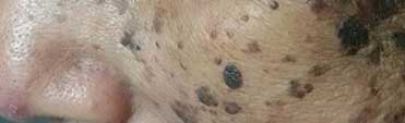 seborrheic-keratosis-before